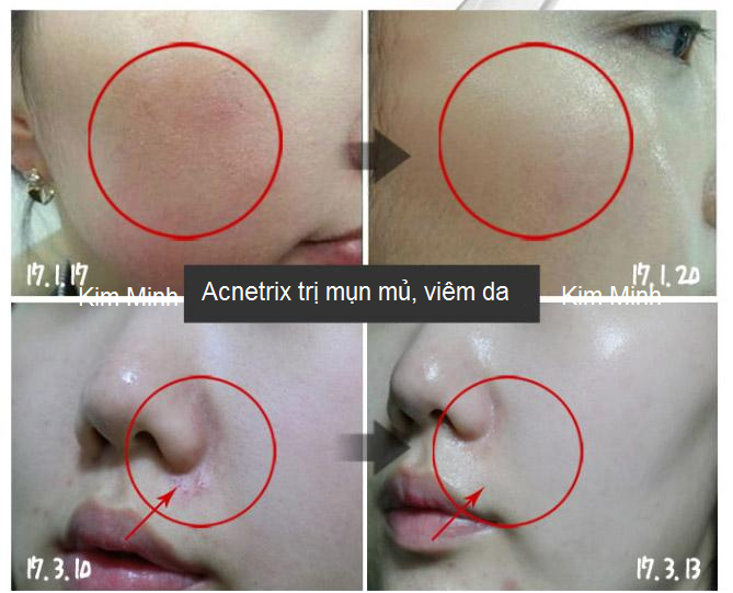 Điều trị da viêm mụn mủ Acnetrix ampoule trước và sau - Y khoa Kim Minh Điều trị mụn mủ, da viêm mụn bằng huyết thanh Acnetrix Ampoule trước và sau - Y Khoa Kim Minh 0933455388