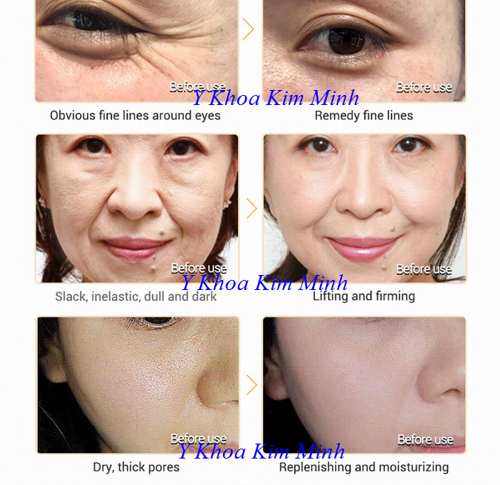 Trước và sau khi sử dụng serum vàng 24K Lanbena chống lão hóa - Y khoa Kim Minh 0933455388