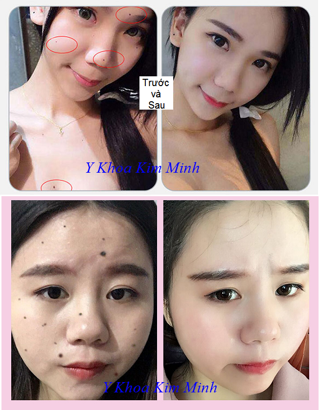 Kết quả chấm nám tàn nhang trước và sau - Y Khoa Kim Minh Hình ảnh trước và sau khi dùng bộ chấm nám tàn nhang - Y khoa Kim Minh