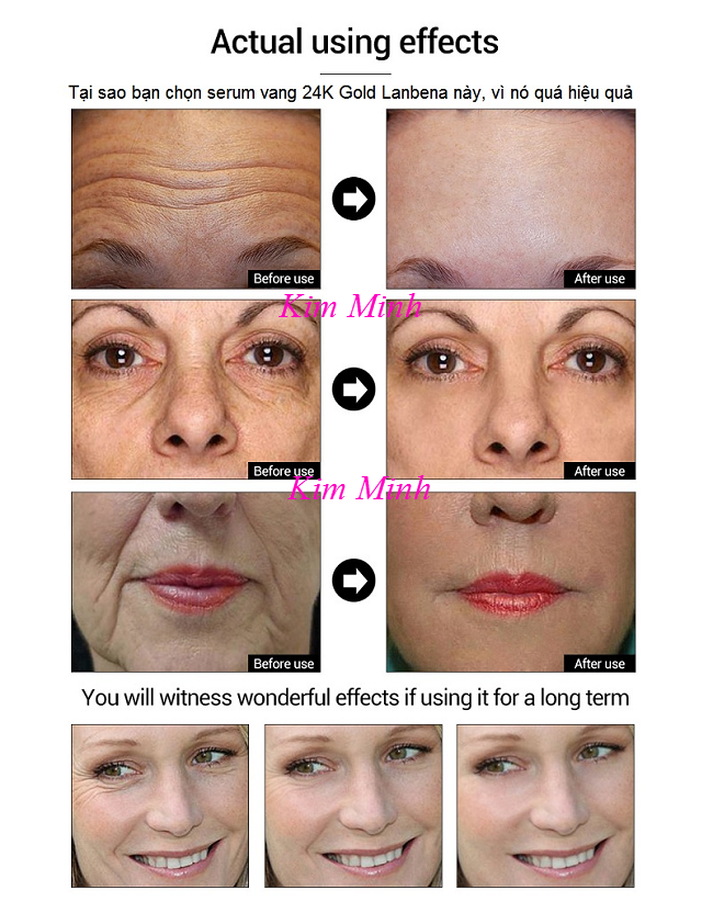 Trước và sau sử dụng serum vàng 24K Lanbena - Y khoa Kim Minh Trước và sau khi sử dụng serum vàng 24K Gold Lanbena - Y khoa Kim Minh
