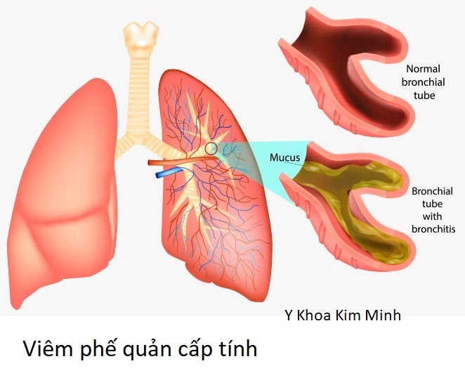 Viêm phế quản cấp tính có nguy hiểm không